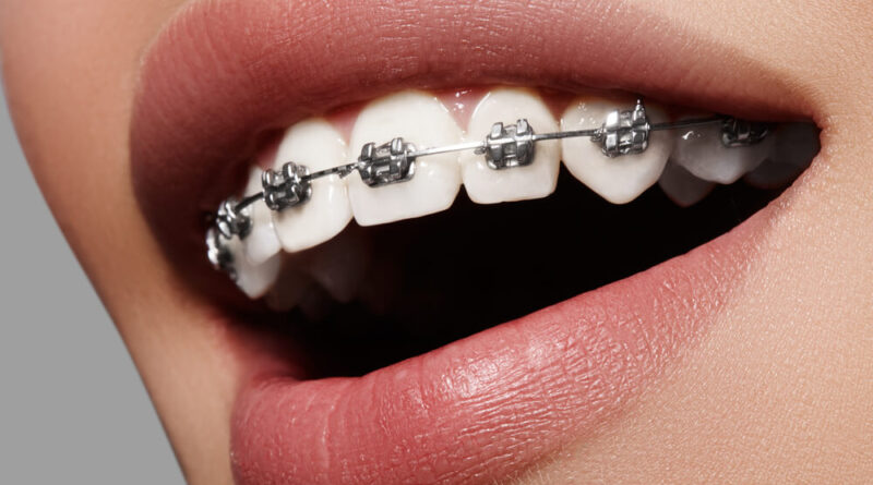 leczenie ortodontyczne piaseczno